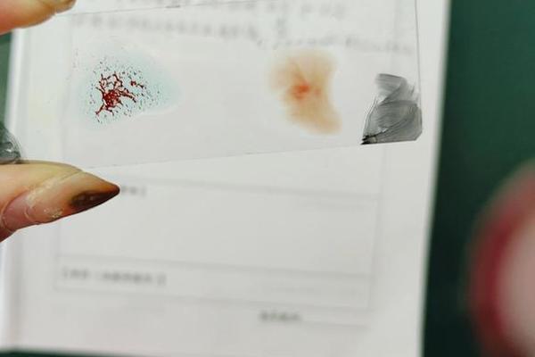 abo血型是a型;abo血型a型血的治疗方法
