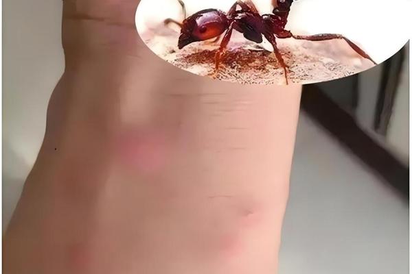 a血型被蚂蚁咬(什么血型招蚂蚁咬)