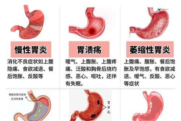 a血型胃—o型血的人容易得胃病吗