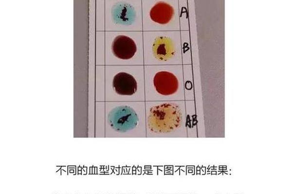 血型抗体效价抗a_血型抗体A效价测定是什么 血型抗体效价抗a_血型抗体A效价测定是什么