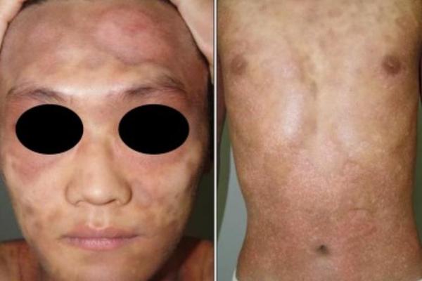 a血型人的皮肤;A型血的人特征
