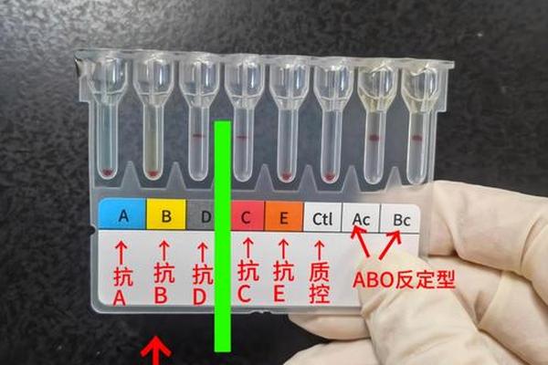a血型还有什么抗体 A血型血清中有什么抗体