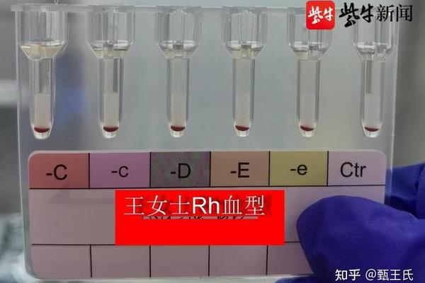 血型A血清-A血型血清中有什么抗体