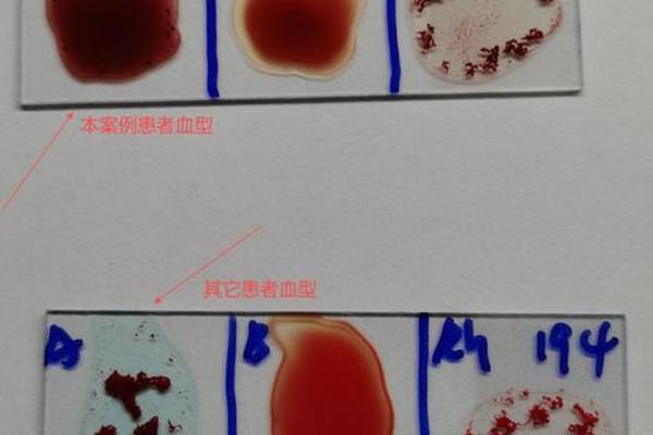 血型ia产生a抗原、A亚型血是O型血的一种吗