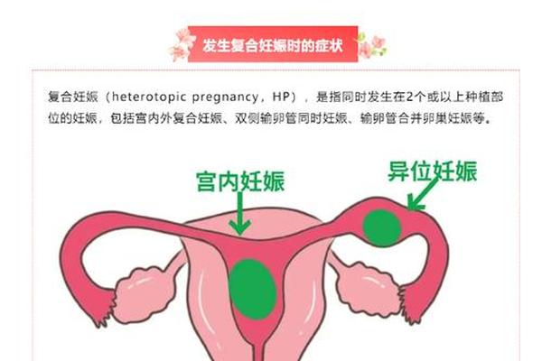 双a血型怀孕几率;双子宫影响怀孕吗