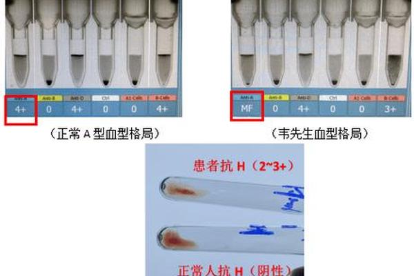 血型鉴定抗a凝集—与抗a血清凝集是什么血型