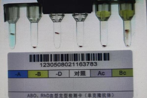 血型最早是a型,a型rh阳性是熊猫血吗