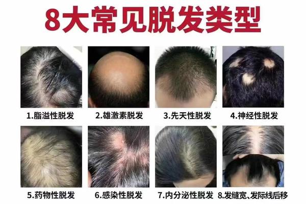 A血型脱发(血型a的女人的性格特点)