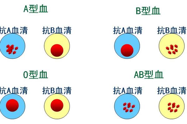 血型a凝集、与抗a凝集是什么血型
