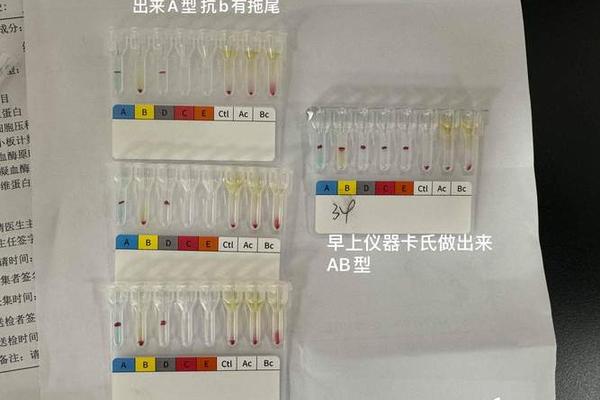 血型鉴定微a形(a+血型和a-型有什么区别)