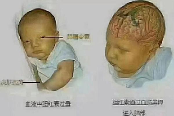 A血型的黄疸、妈妈是A型血宝宝黄疸难退吗