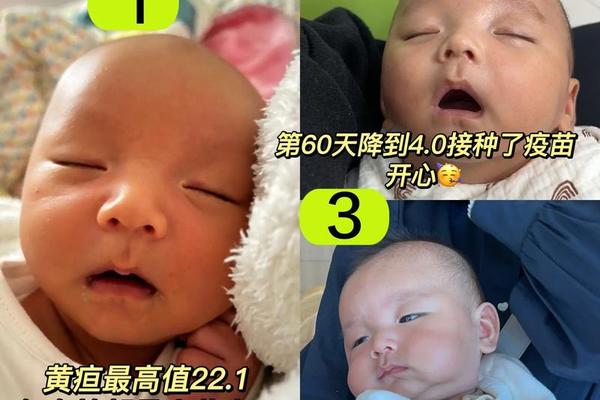 黄疸18血型A-新生儿黄疸跟父母血型有关系吗