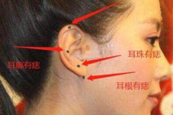 麻衣相 耳朵痣;痣在耳朵图片大全