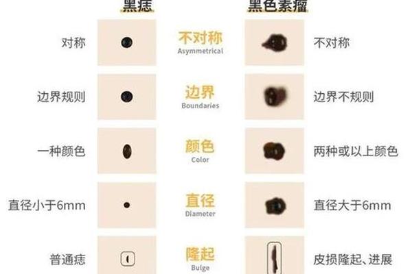 黑色素瘤在痣相算吗,哪些痣会变成黑色素瘤