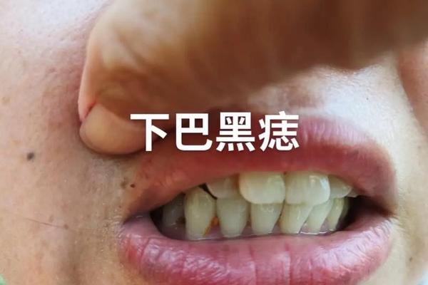 下巴底下藏着的暗痣痣相 女人下巴底正中间长痣