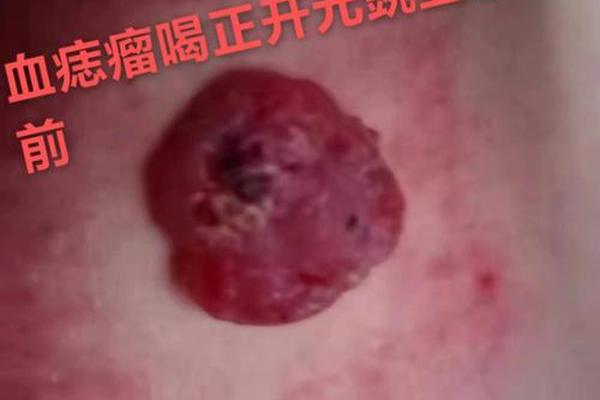 痣相红色—正常红痣的图片