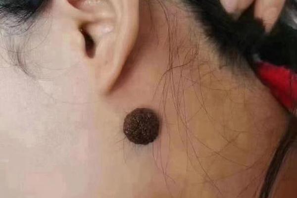 痣相突出来的,突出来的痣好吗