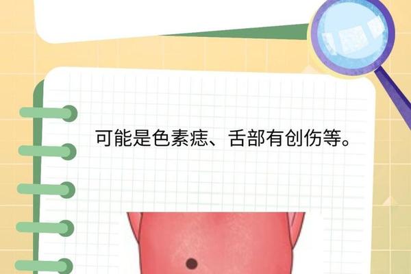 舌头 痣 相,舌头长痣代表什么命运