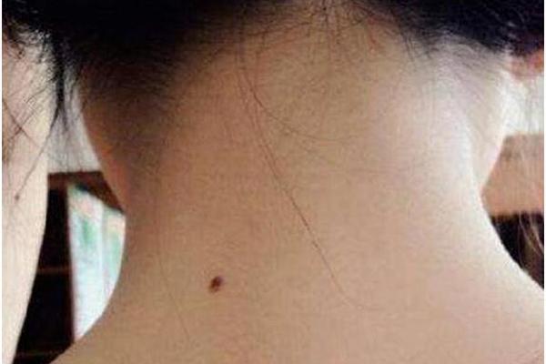 痣相女人脖子痣相图解、女人后脖子有痣