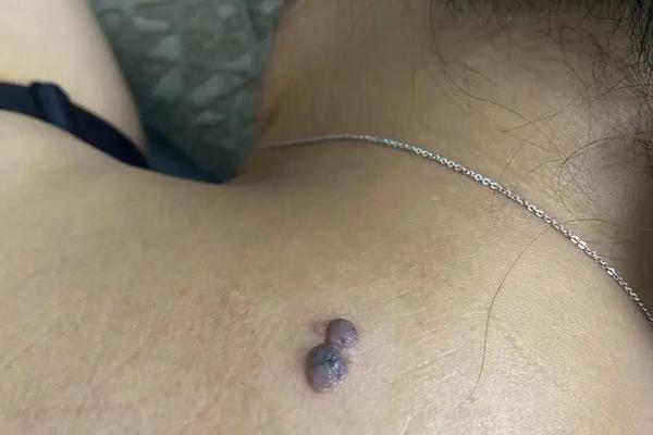 看痣相腰左边有一粒肉痣(后腰长了一颗肉痣)