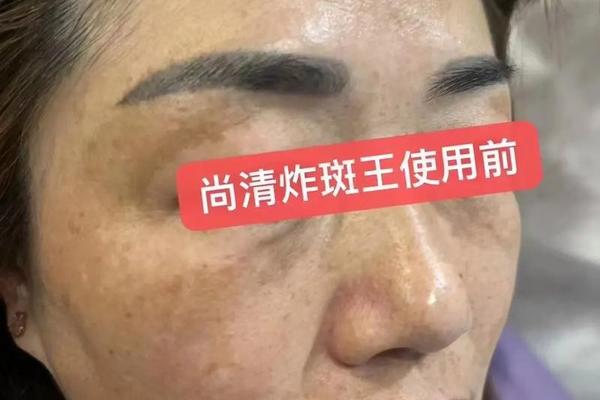 北相痣斑王(痣斑王点痣效果怎么样)