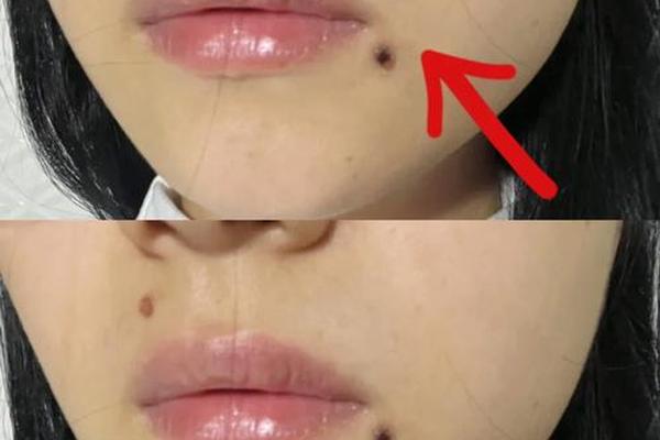 相城医院点痣多少钱啊 苏州哪里点痣比较好