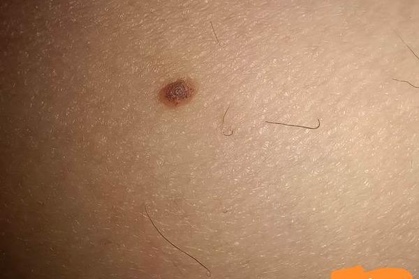 大腿根有痣命运图 痣相、大腿后面有痣图解