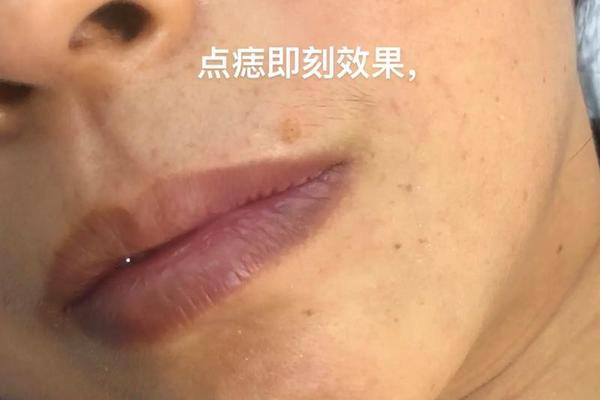 观相女人被点痣视频播放 自己在家怎么点痣视频
