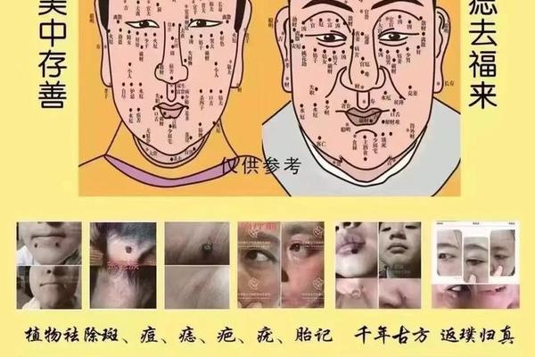 重庆痣相-重庆哪个医院祛痣比较权威