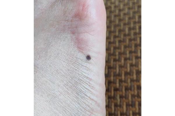 女人左右脚背长痣的相格—女人左脚背上有痣代表什么