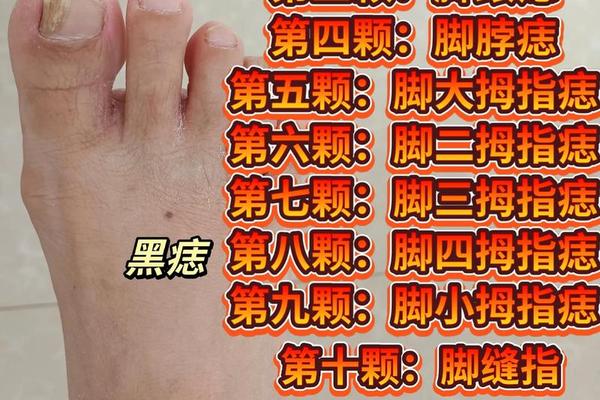 痣相女人脚趾头痣相图解-面相痣的图片大全