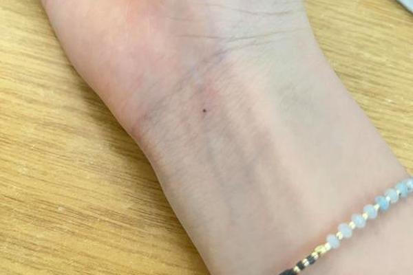 女相手腕有痣代表什么预兆、手腕有痣的女人代表什么意思