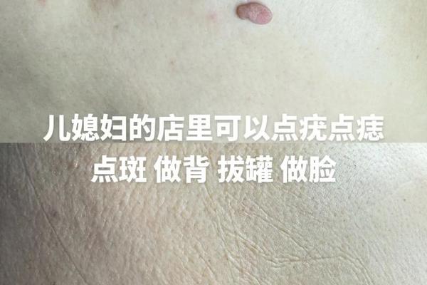 与皮肤相平的痣怎么去掉(痣不规则但是平的)