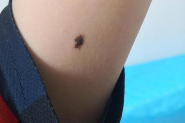 痣相上凸起的痣;胳膊上有痣代表什么