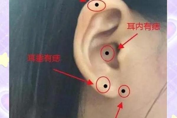 痣相耳部、耳朵长痣的位置代表什么