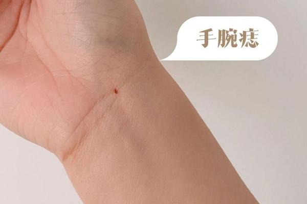 手腕痣相解图 女生手上痣代表什么