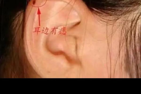耳相有痣;女人痣相图解十大福痣