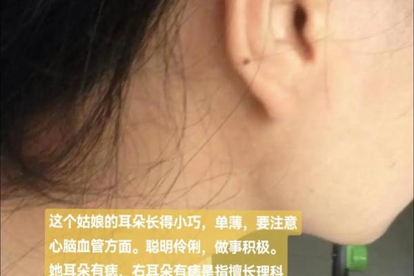 耳相带痣,痣相可信吗