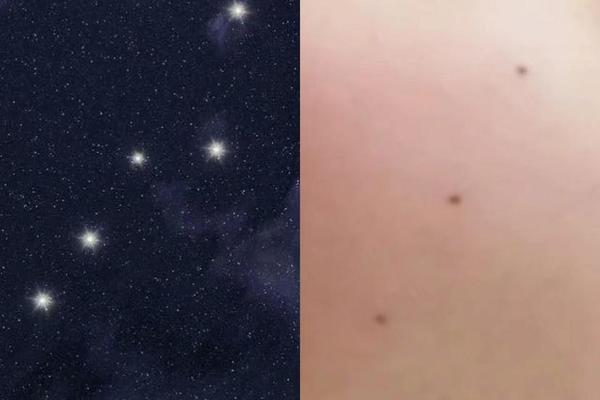 七星痣是吉相_七星痣一般在什么地方