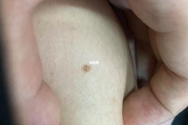 肚痣相;肚子痣图片