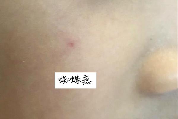 痣相有小红痣图片 小红痣的图片