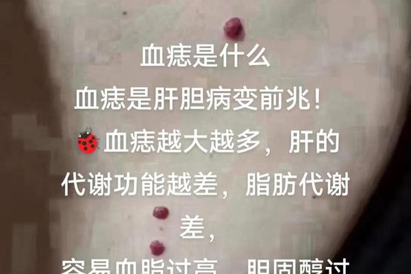 九世血痣只为换一世相守-血痣与红痣的区别图片