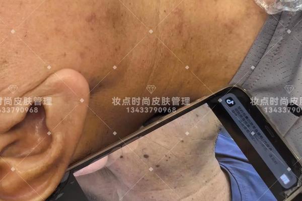 痣相纹身颜色深怎么办-纹身后觉得颜色太深了