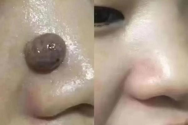 凸起痣痣相-凸起来的痣是什么