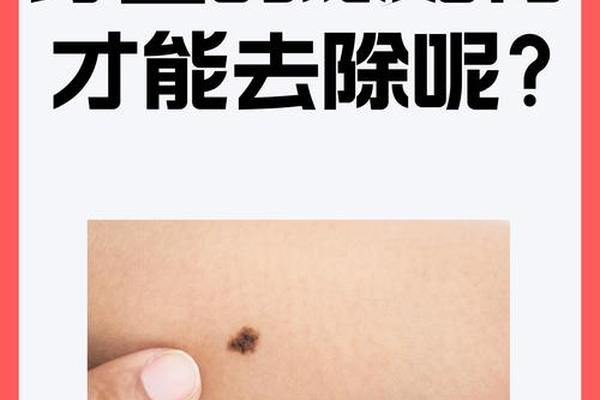 与皮肤相平的痣怎么去掉(痣不规则但是平的)