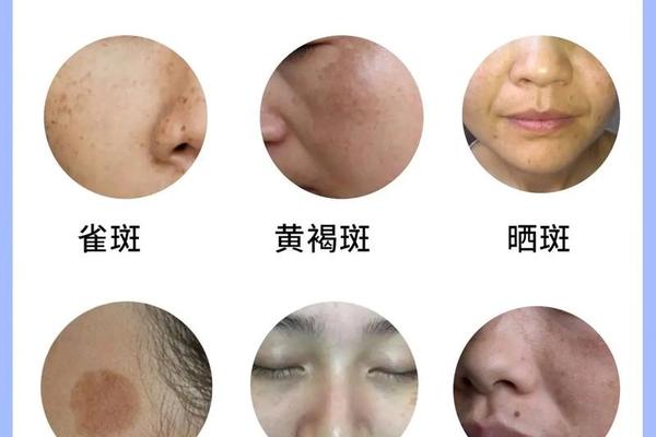 斑点是痣相之内一种吗,斑和痣有什么区别