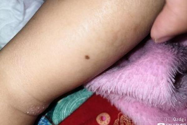 痣相女腿—大腿内侧有痣的女人代表什么 痣相女腿—大腿内侧有痣的女人代表什么