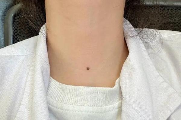 文相敏脖子痣;右脖子有痣的明星