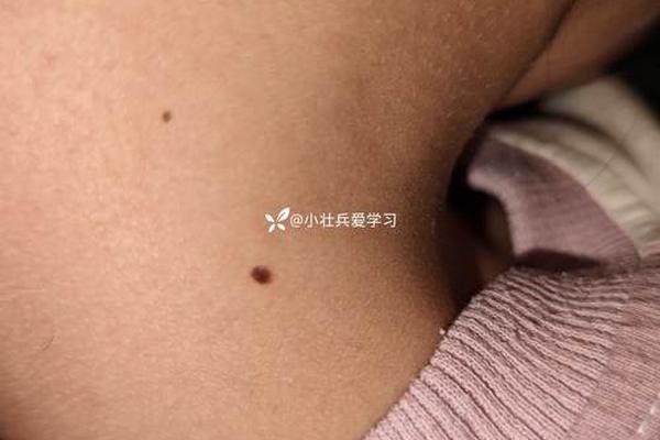 小孩痣相-儿童痣图片大全