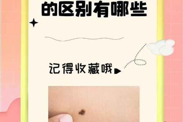 痣相真实案例—痣良性和恶性区别图片对比